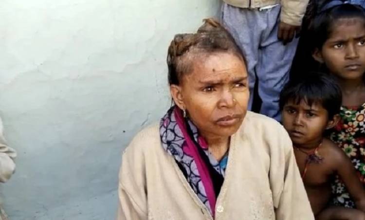 Doktorlar çaresini bulamadı: Hindistan'da bir kadının kafasında boynuz çıkıyor